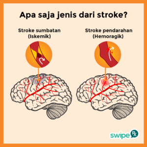 Jenis stroke